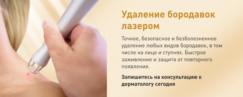 Удаление бородавок в клинике в Москве